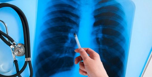 ЯК НЕ СПЛУТАТИ COVID-19 З ТУБЕРКУЛЬОЗОМ